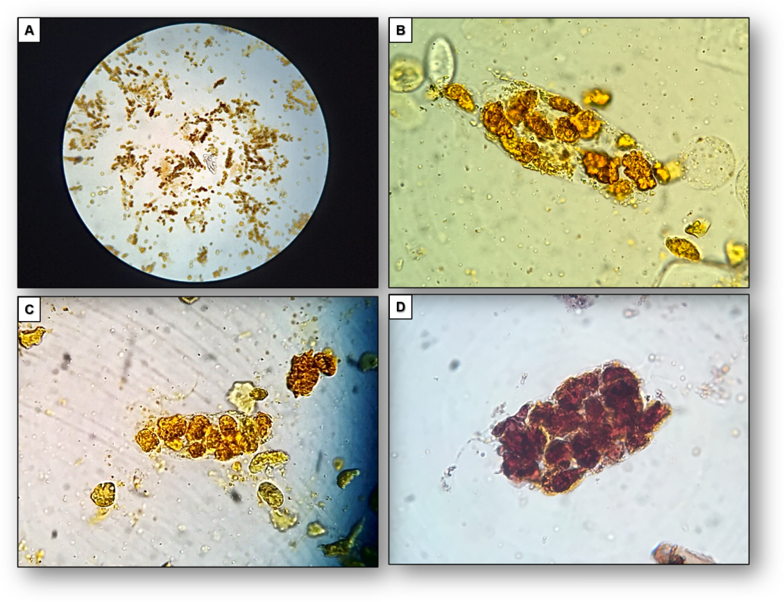Urine Sediment of the Month Findings in Cirrhosis, Cholestasis, and