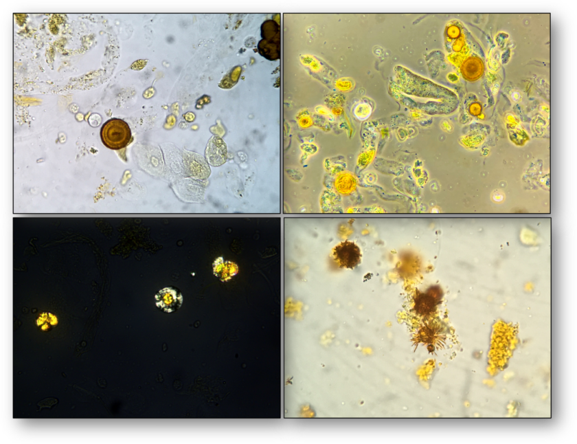 Urine Sediment of the Month Findings in Cirrhosis, Cholestasis, and