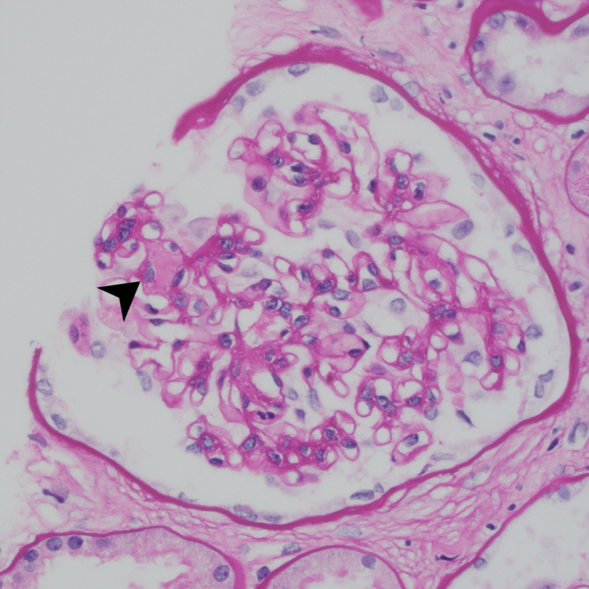 Kidney Biopsy of the Month: Amyloidosis - Renal Fellow Network