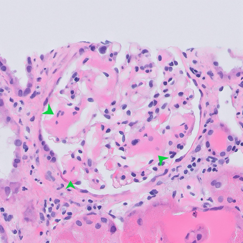 Kidney Biopsy of the Month Amyloidosis Renal Fellow Network