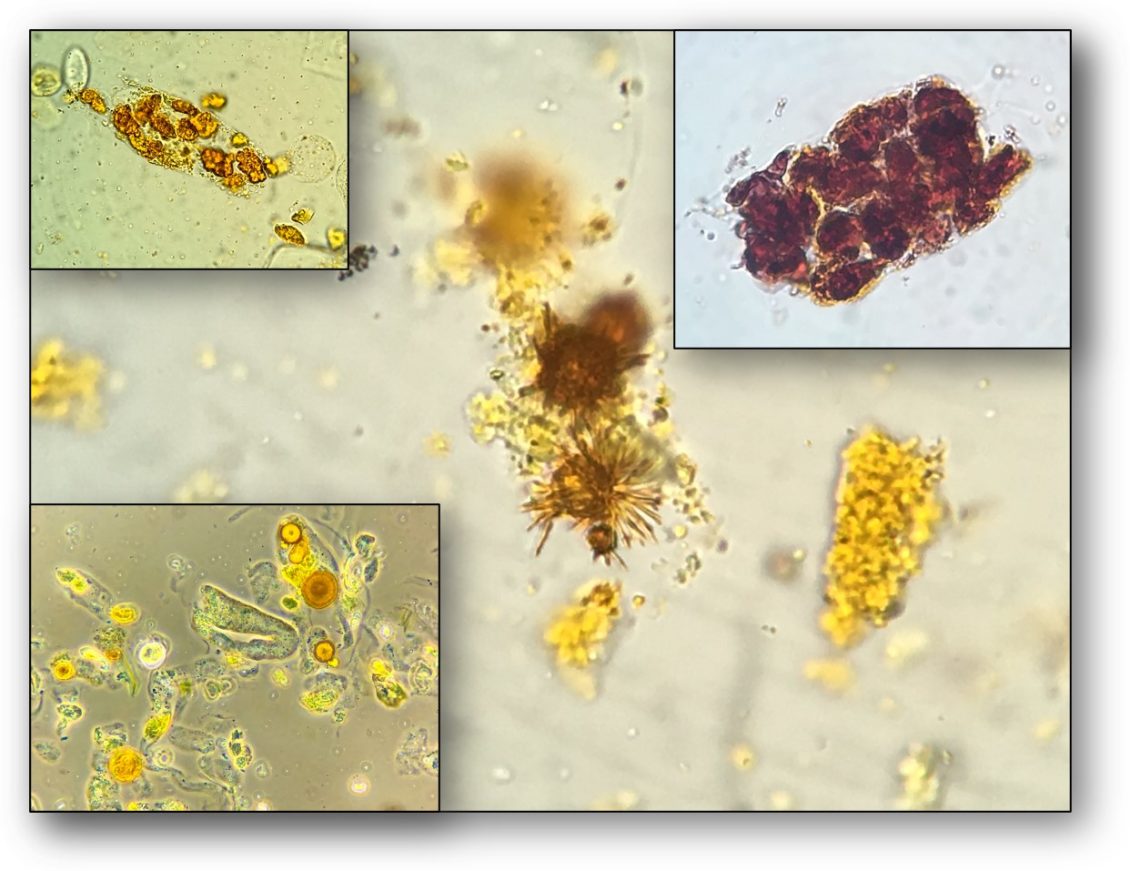 Urine Sediment of the Month Findings in Cirrhosis, Cholestasis, and