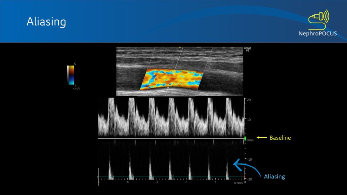 Basics of Doppler Ultrasound for the Nephrologist Part 2 Renal