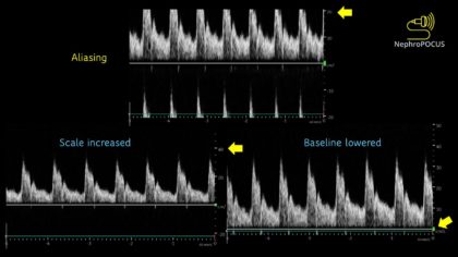 Aliasing Radiography Basics of Doppler Ultrasound for the Nephrologist- Part 2 - Renal ...