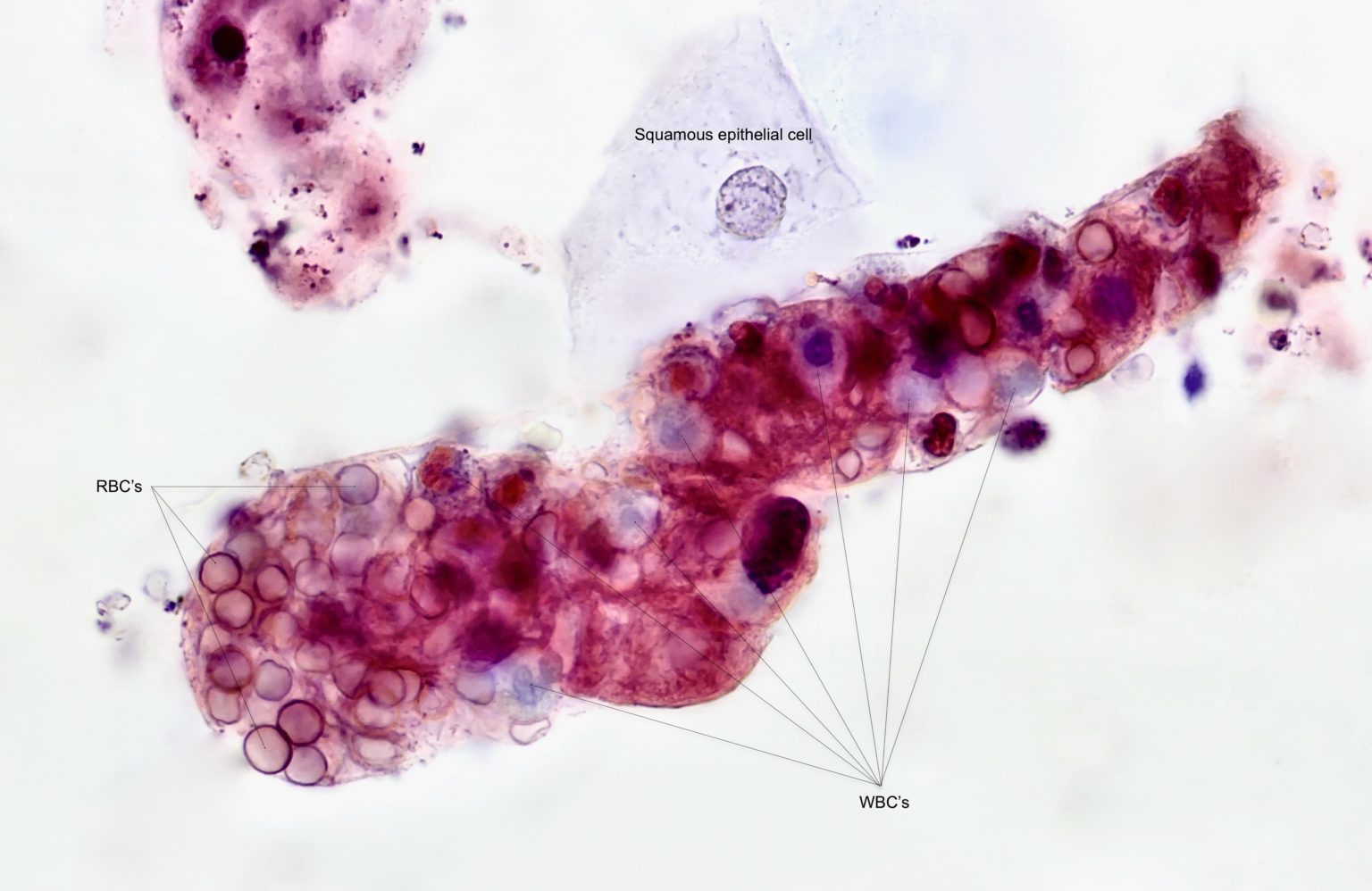 Urine Sediment of the Month Mixed Cellular Casts Renal Fellow Network