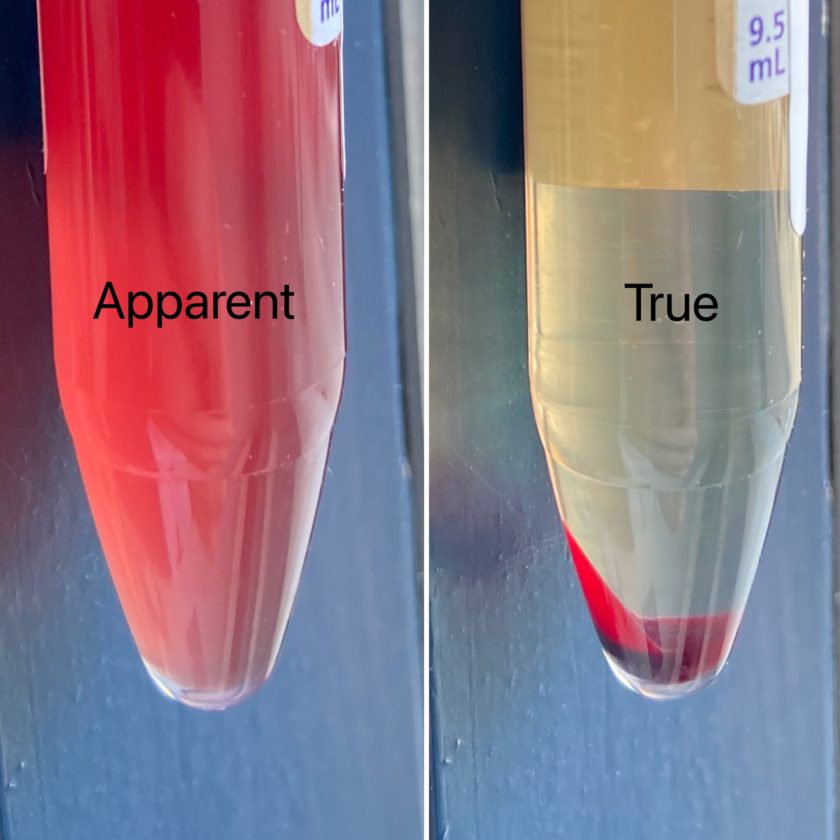 Urine Sediment of the Month: Urine's True Colors - Renal Fellow Network