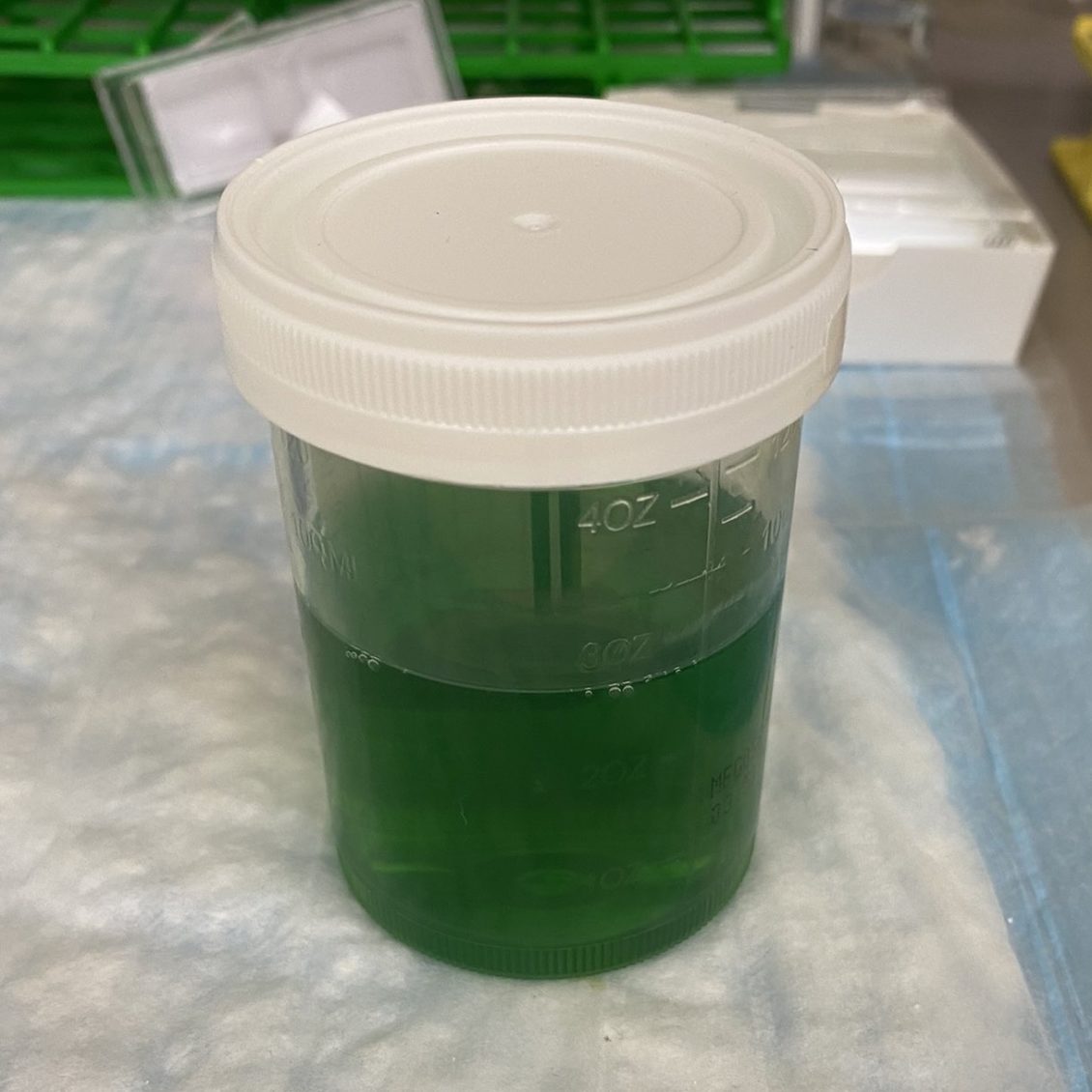 Urine Sediment of the Month Urine's True Colors Renal Fellow Network