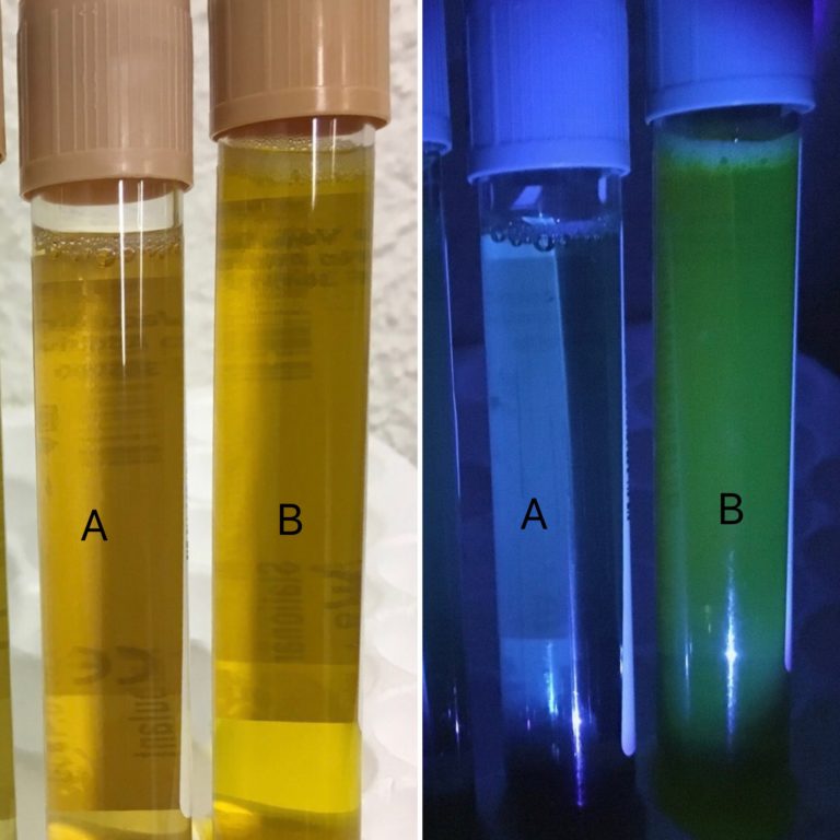 Urine Sediment of the Month Urine's True Colors Renal Fellow Network