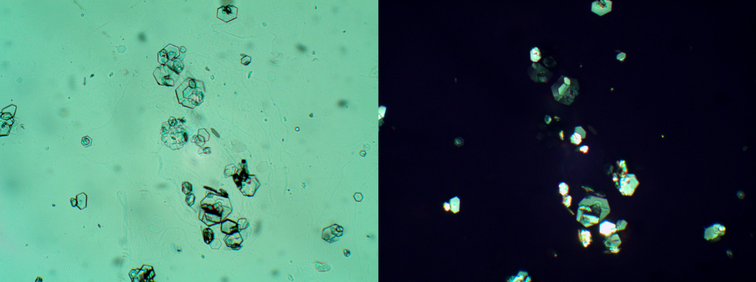 Urine Sediment of the Month Pathologic Crystals in the Urine Renal