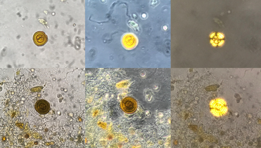 Urine Sediment of the Month Pathologic Crystals in the Urine Renal