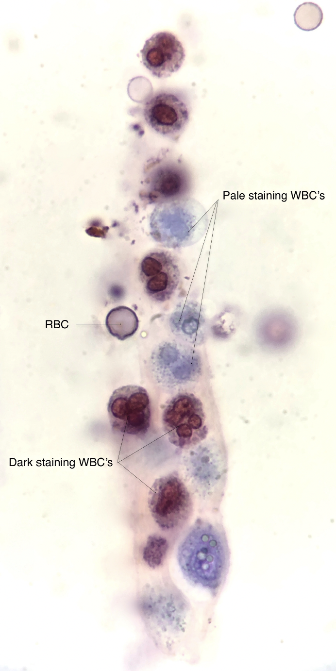 Urine Sediment of the Month To Stain or Not to Stain Renal Fellow