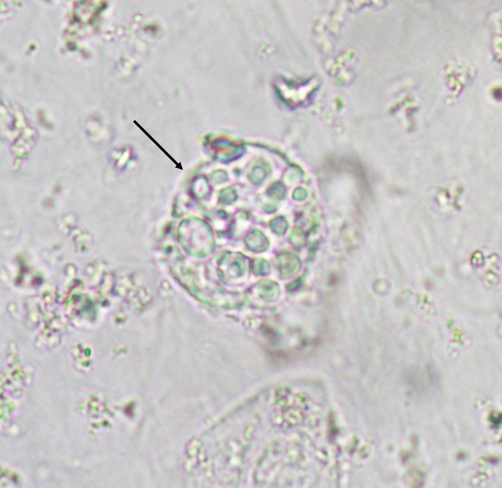 macrophage in urine sediment