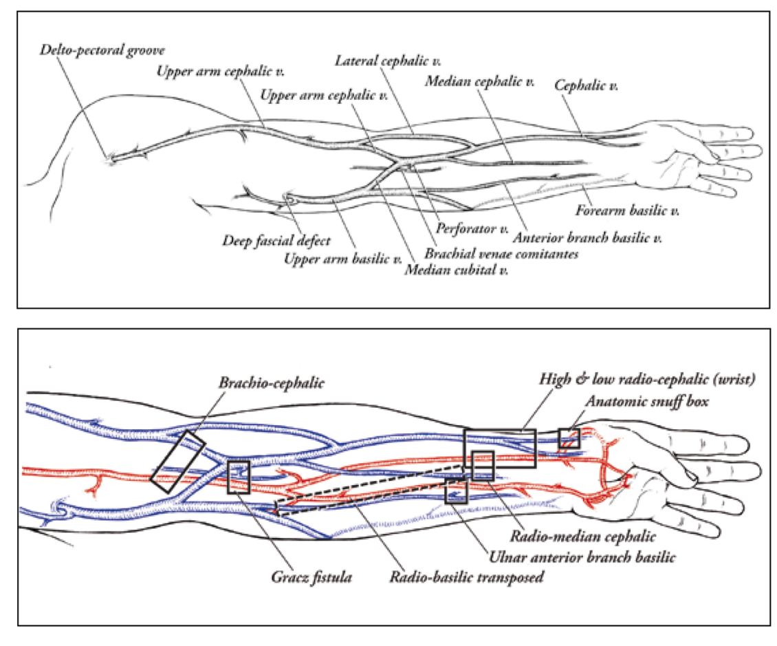 Cannulate No Fistula Before It’s Time AVF Maturation 101 Renal