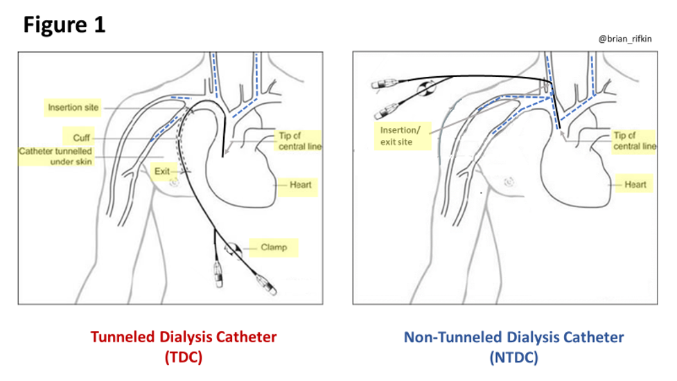 Tunnelled Central Venous Line